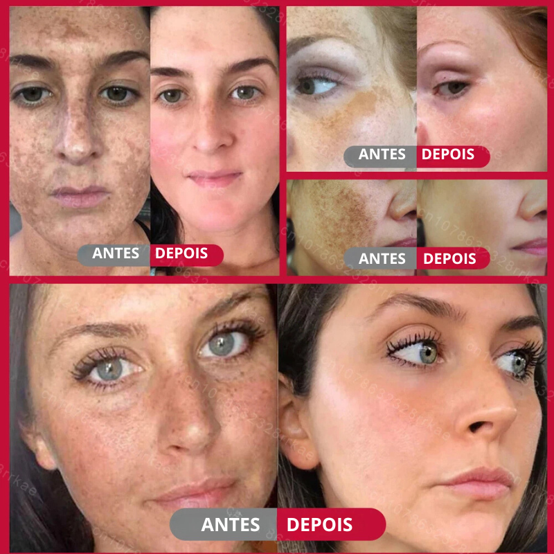 Clareador de sardas remove melasma manchas escuras, ilumina a pele e anti-envelhecimento