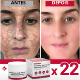 Clareador de sardas remove melasma manchas escuras, ilumina a pele e anti-envelhecimento