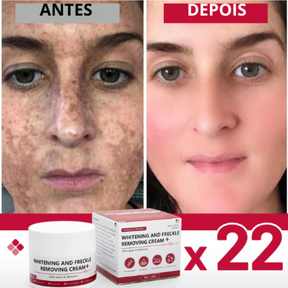 Clareador de sardas remove melasma manchas escuras, ilumina a pele e anti-envelhecimento