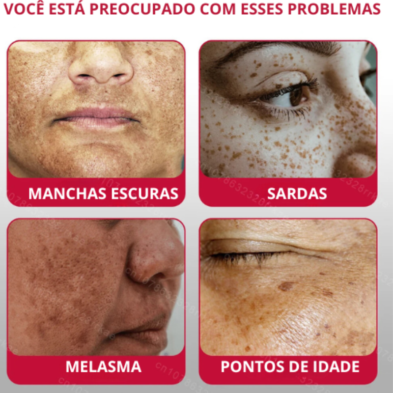 Clareador de sardas remove melasma manchas escuras, ilumina a pele e anti-envelhecimento